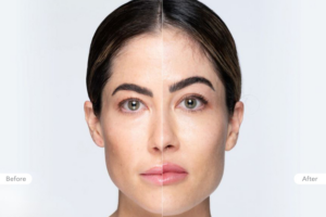 Clinical Outcomes Revanesse