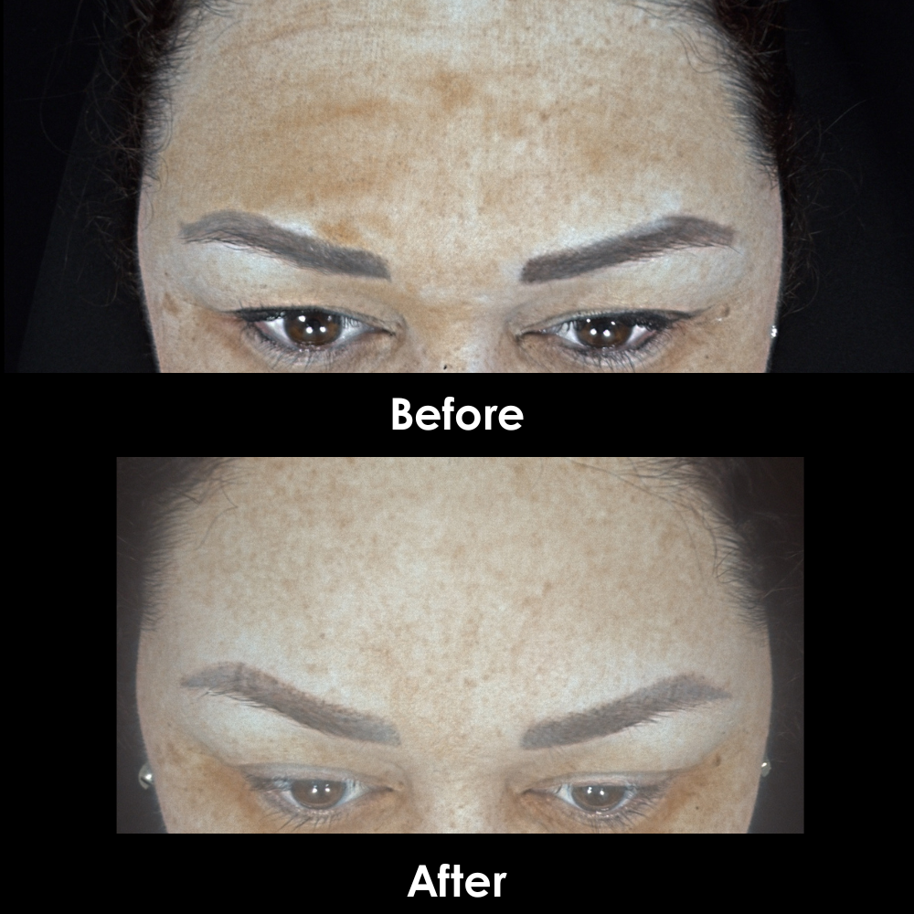 Before and After Forehead