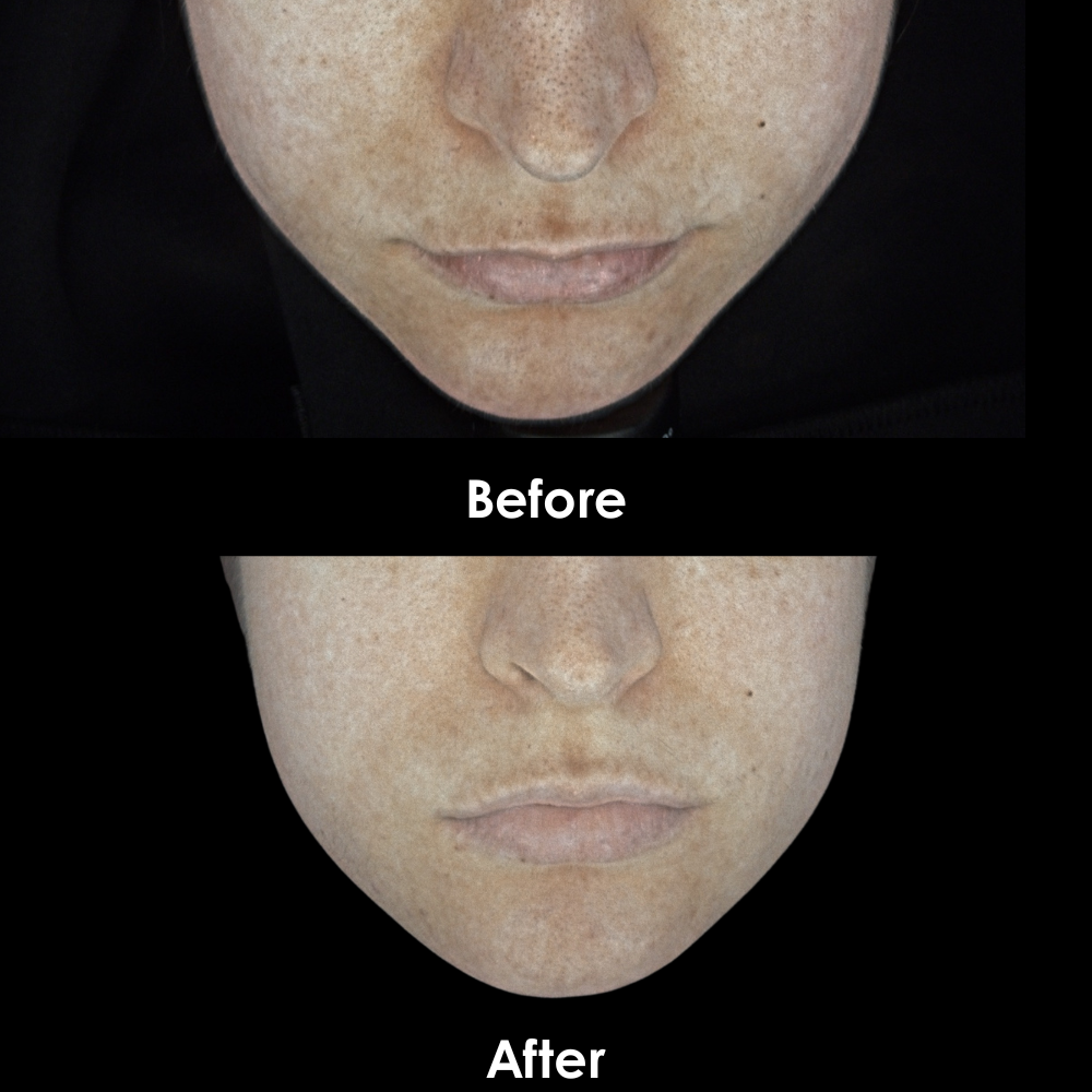 Before and After Mouth